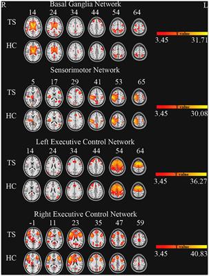 Frequency-Specific Regional Homogeneity Alterations in Tourette Syndrome